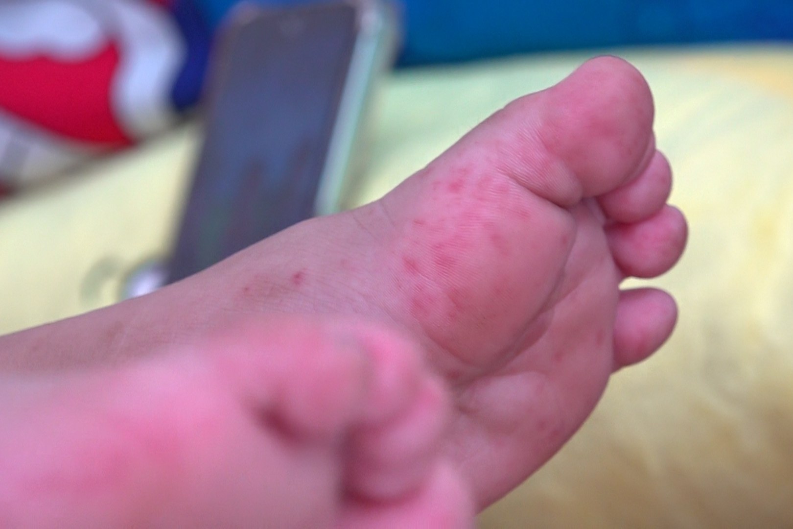 Strengthening the prevention and control of hand, foot, and mouth epidemic in Hanoi