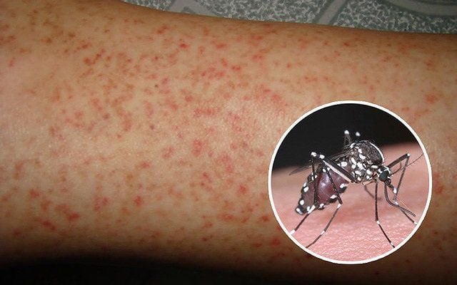 Chủ động tăng cường giám sát, phòng, chống sốt xuất huyết